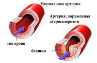 Как укрепить сосуды