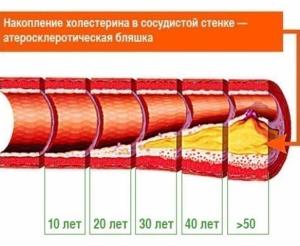 Проверенные поколениями народные средства от холестерина